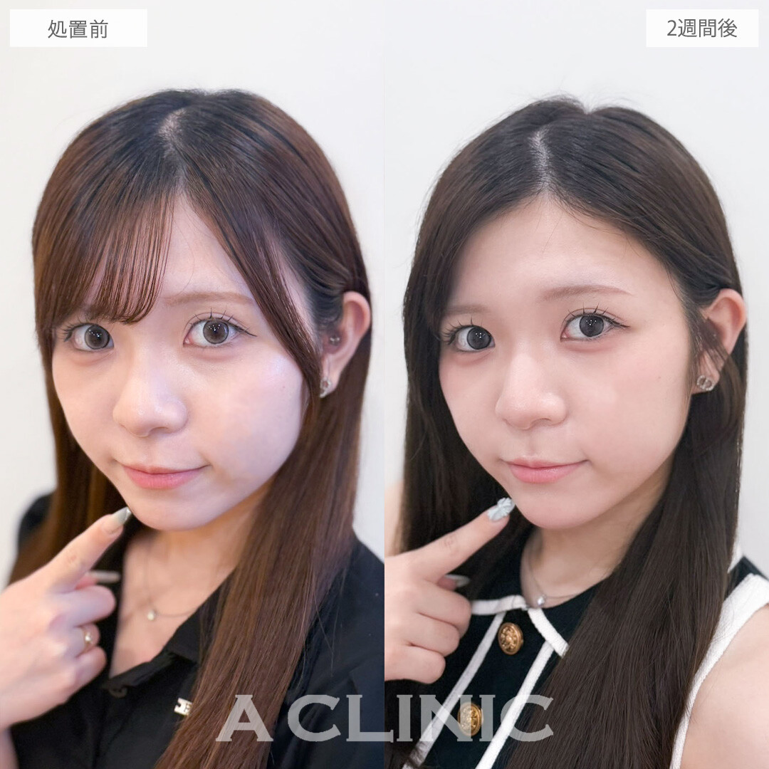 ヒアルロン酸カスタマイズメニューで目の下の影とあごの形を整え一気に垢抜け！こちら処置前と2週間後の症例です(20代女性)