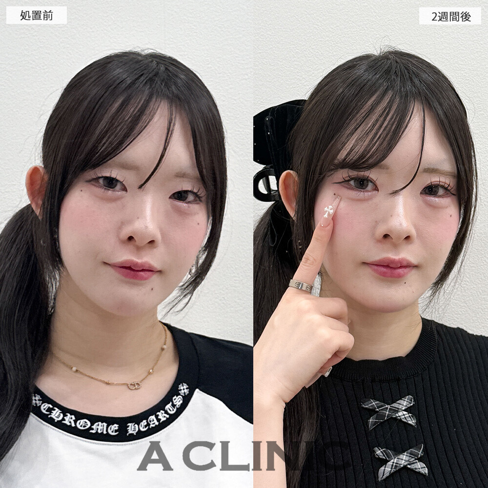 二重術埋没法で柔らかい印象に！こちら処置前と2週間後の症例です(20代女性)
