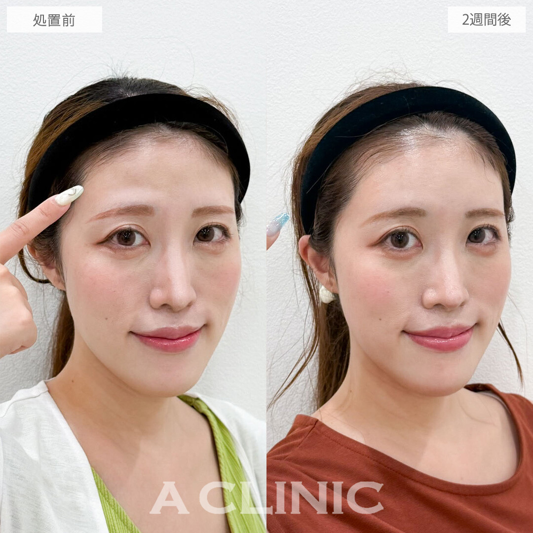 額出し(ヒアルロン酸注入)で丸みのある可愛いおでこになって優しい印象に！こちら処置前と2週間後の症例です(30代女性)