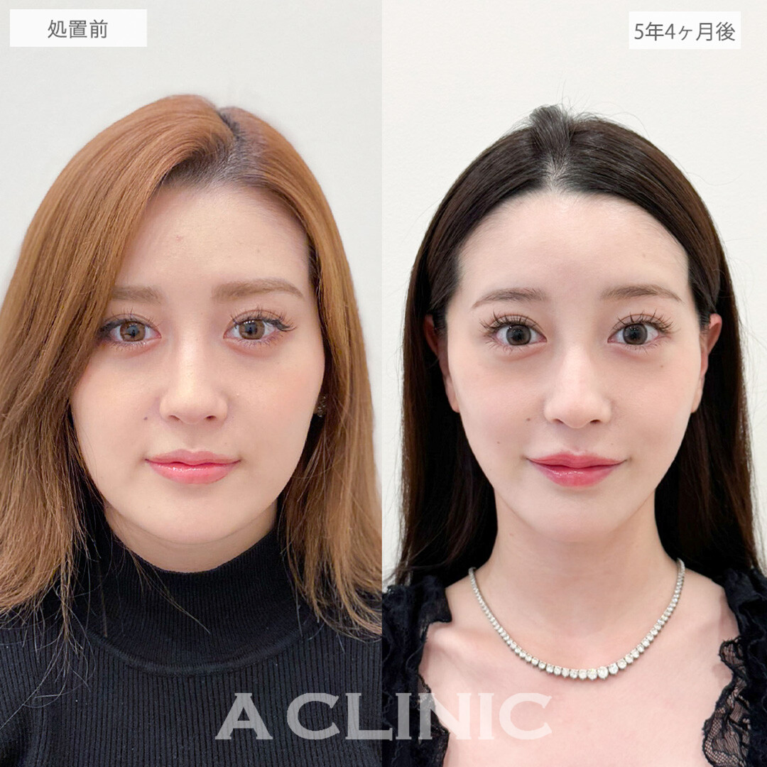 1day小顔脂肪吸引で5年経ってもリバウンド知らずで輪郭そのまま！処置前と5年4ヶ月後の症例です(20代女性)