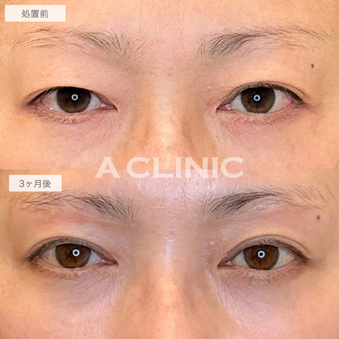眉下リフトで目の開きが改善！処置前と3ヶ月後の症例です(40代女性)