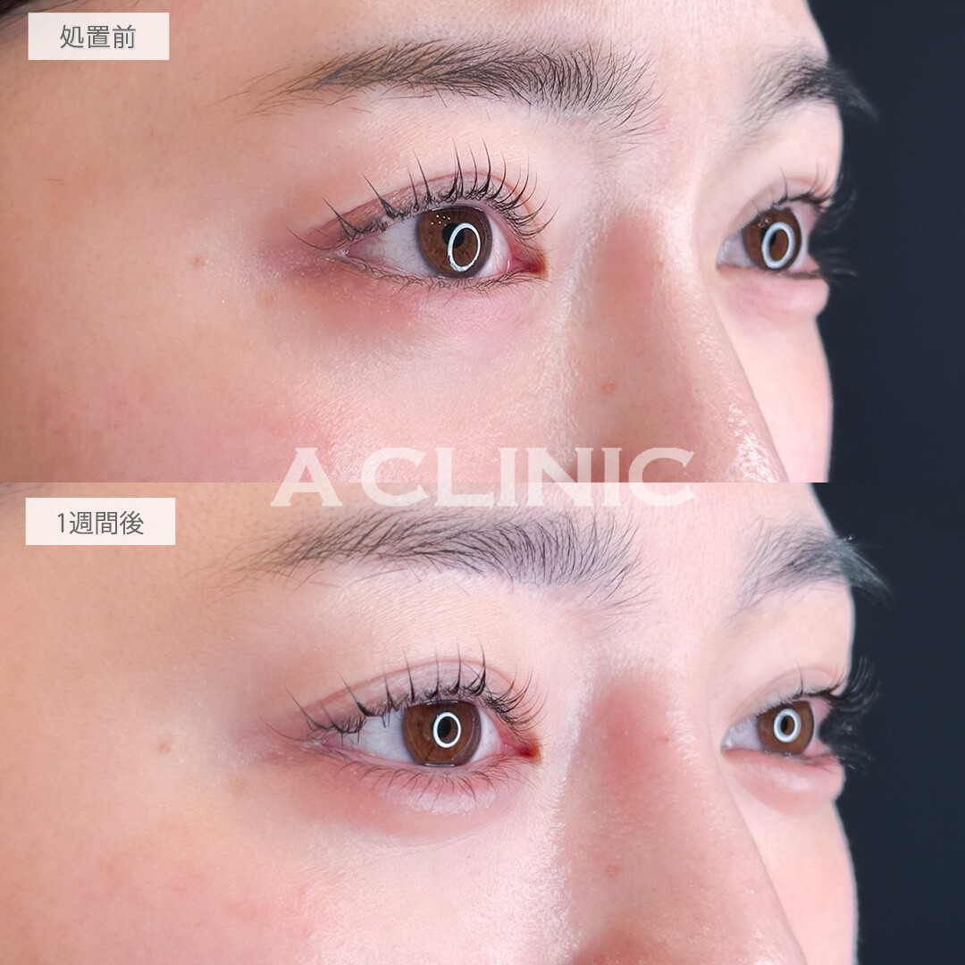 涙袋形成術(ヒアルロン酸)でぷっくりうるうるな目元にアップデート！処置前と1週間後の症例です(20代女性)