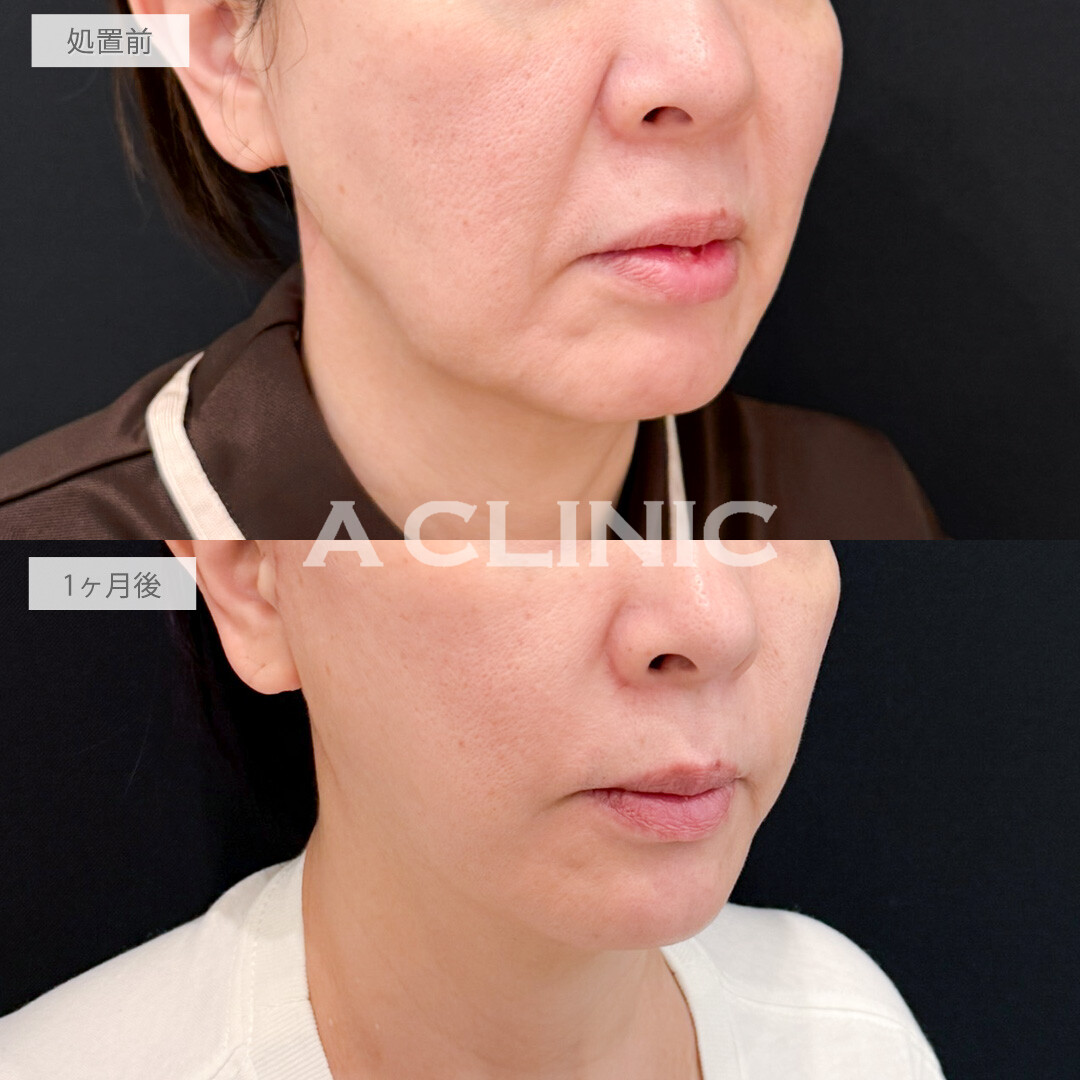 A式ナゾラリフトでほうれい線が薄くなるだけでお顔全体がここまで一気に若返って見えます！処置前と1ヶ月後の症例です(50代女性)