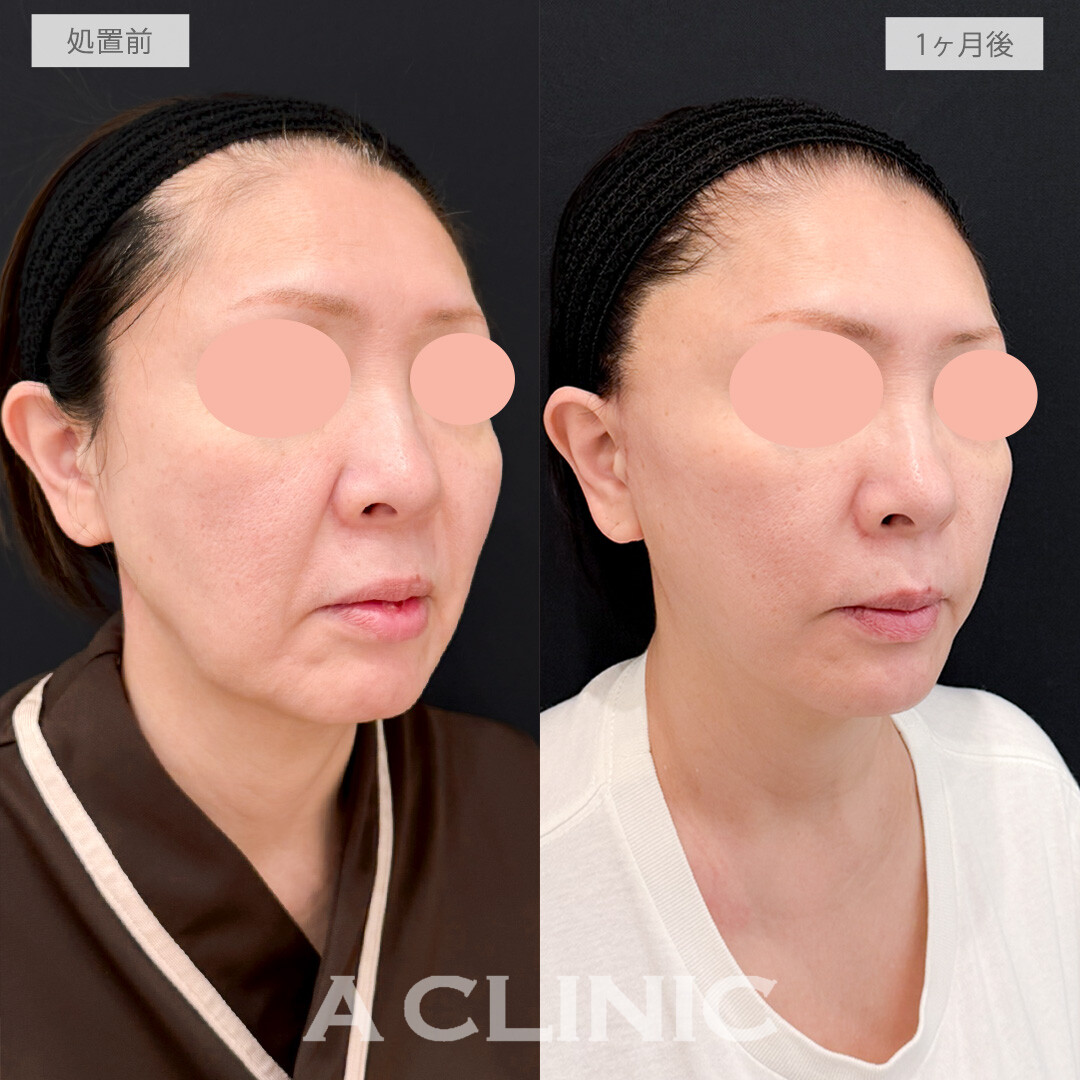A式ナゾラリフトでほうれい線が薄くなるだけでお顔全体がここまで一気に若返って見えます！処置前と1ヶ月後の症例です(50代女性)