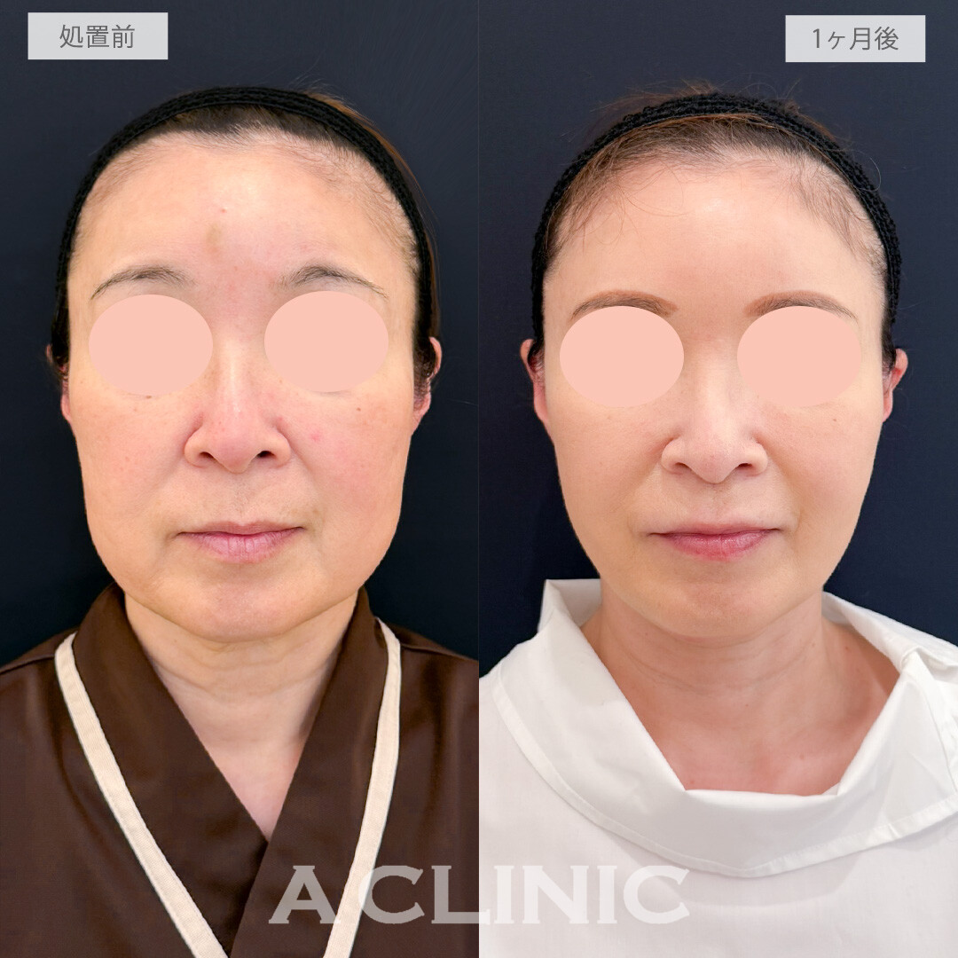 A式ナゾラリフトとバッカルファット除去術で周りと圧倒的に差がつく若返り効果を発揮！処置前と1ヶ月後の症例です(50代女性)