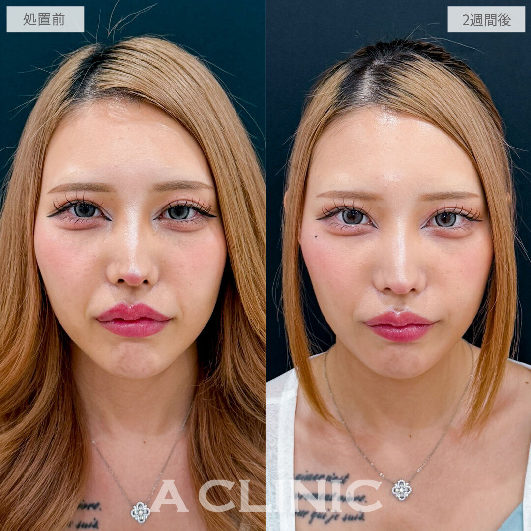 A式ナゾラリフトで究極の垢抜けフェイスラインに！こちら処置前と2週間後の症例です(20代女性)