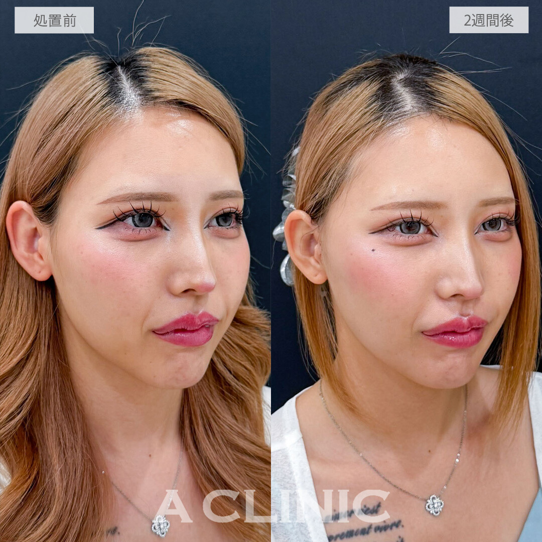 A式ナゾラリフトで究極の垢抜けフェイスラインに！こちら処置前と2週間後の症例です(20代女性)