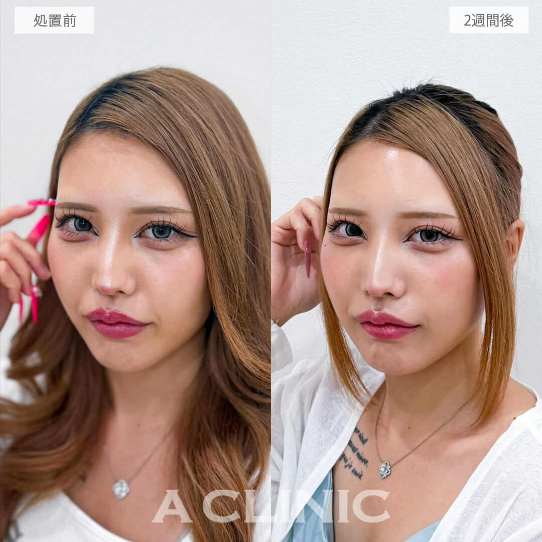 A式ナゾラリフトで究極の垢抜けフェイスラインに！こちら処置前と2週間後の症例です(20代女性)