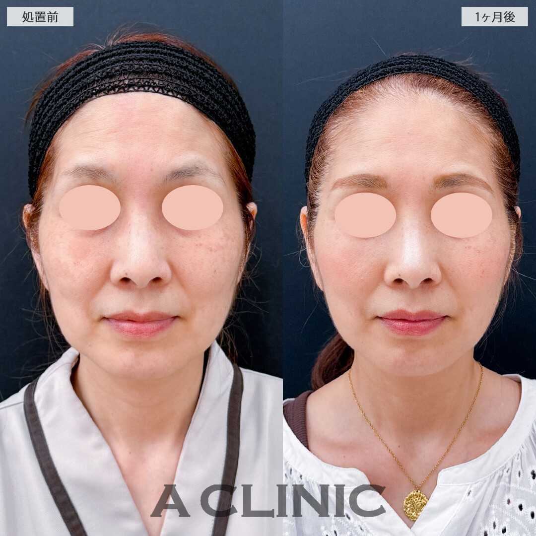 1day小顔脂肪吸引でもたつきをすっきりさせ360度どこから見ても若々しい小顔に！こちら処置前と1か月後の症例です(50代女性)