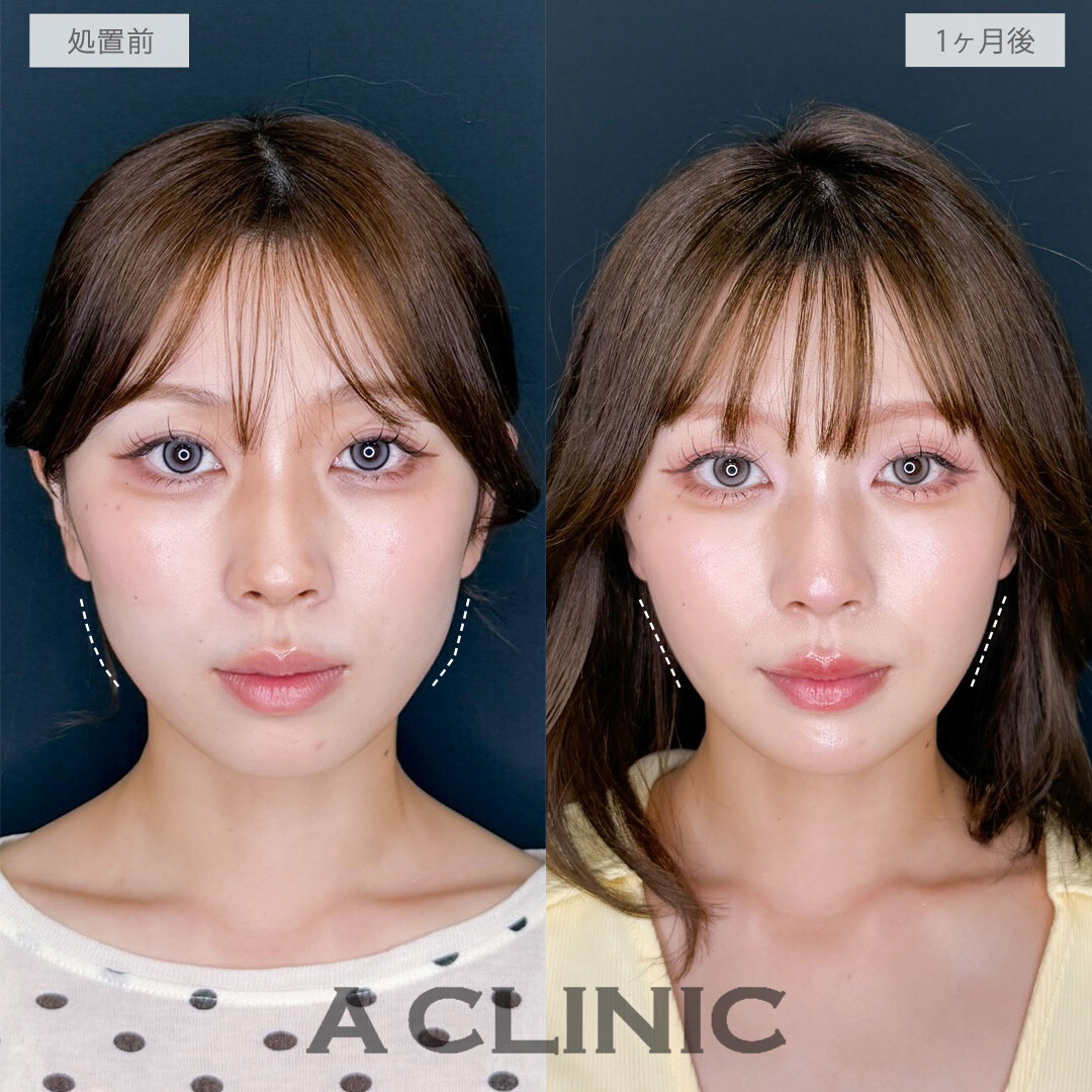 1day小顔脂肪吸引は直後から腫れずに理想の小顔を手に入れることができる施術です！処置前から1か月後の症例です(20代女性)