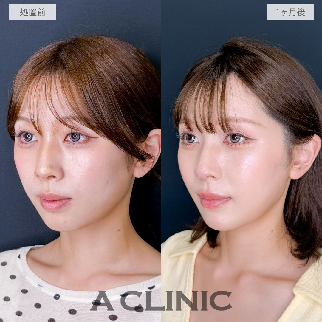 1day小顔脂肪吸引は直後から腫れずに理想の小顔を手に入れることができる施術です！処置前から1か月後の症例です(20代女性)