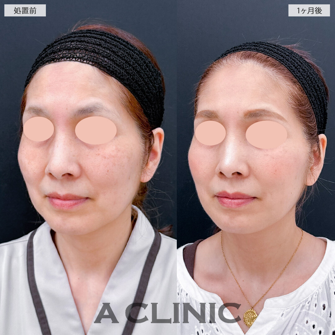 1day小顔脂肪吸引でもたつきをすっきりさせ360度どこから見ても若々しい小顔に！こちら処置前と1か月後の症例です(50代女性)