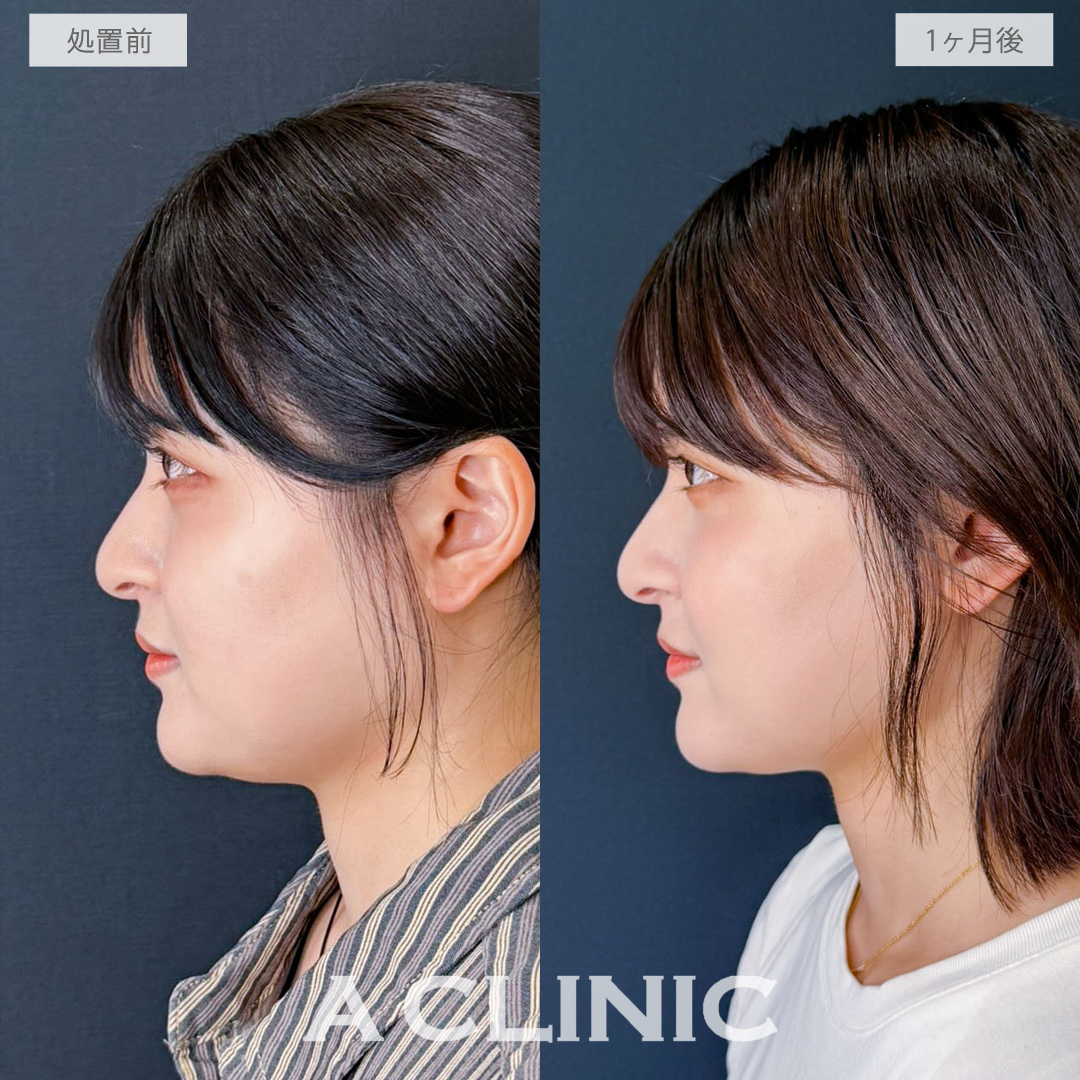 1day小顔脂肪吸引でフェイスラインとあご下をすっきりさせて美シルエットの小顔へ！こちら処置前と1か月後の症例です(20代女性)