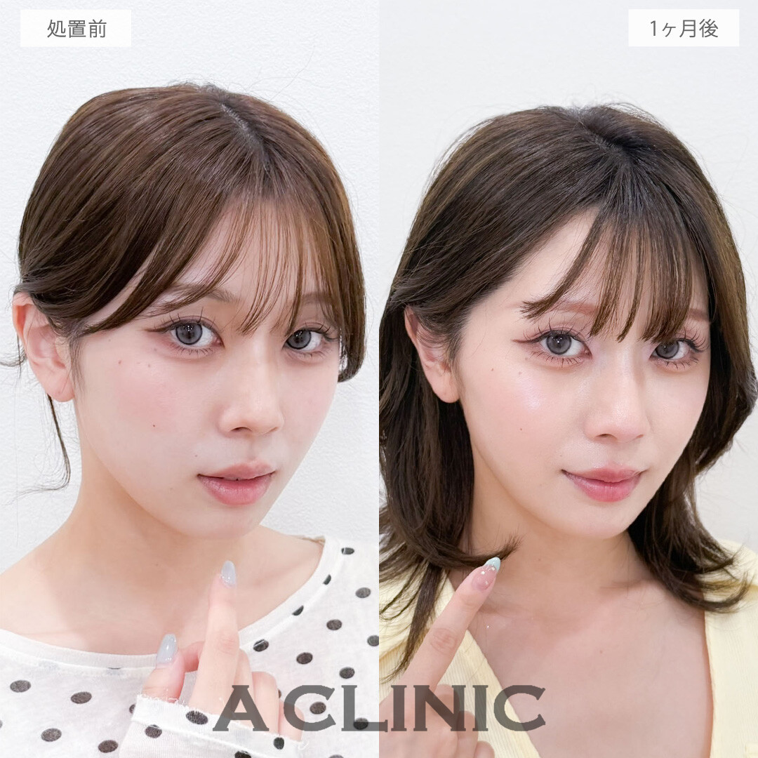 1day小顔脂肪吸引は直後から腫れずに理想の小顔を手に入れることができる施術です！処置前から1か月後の症例です(20代女性)