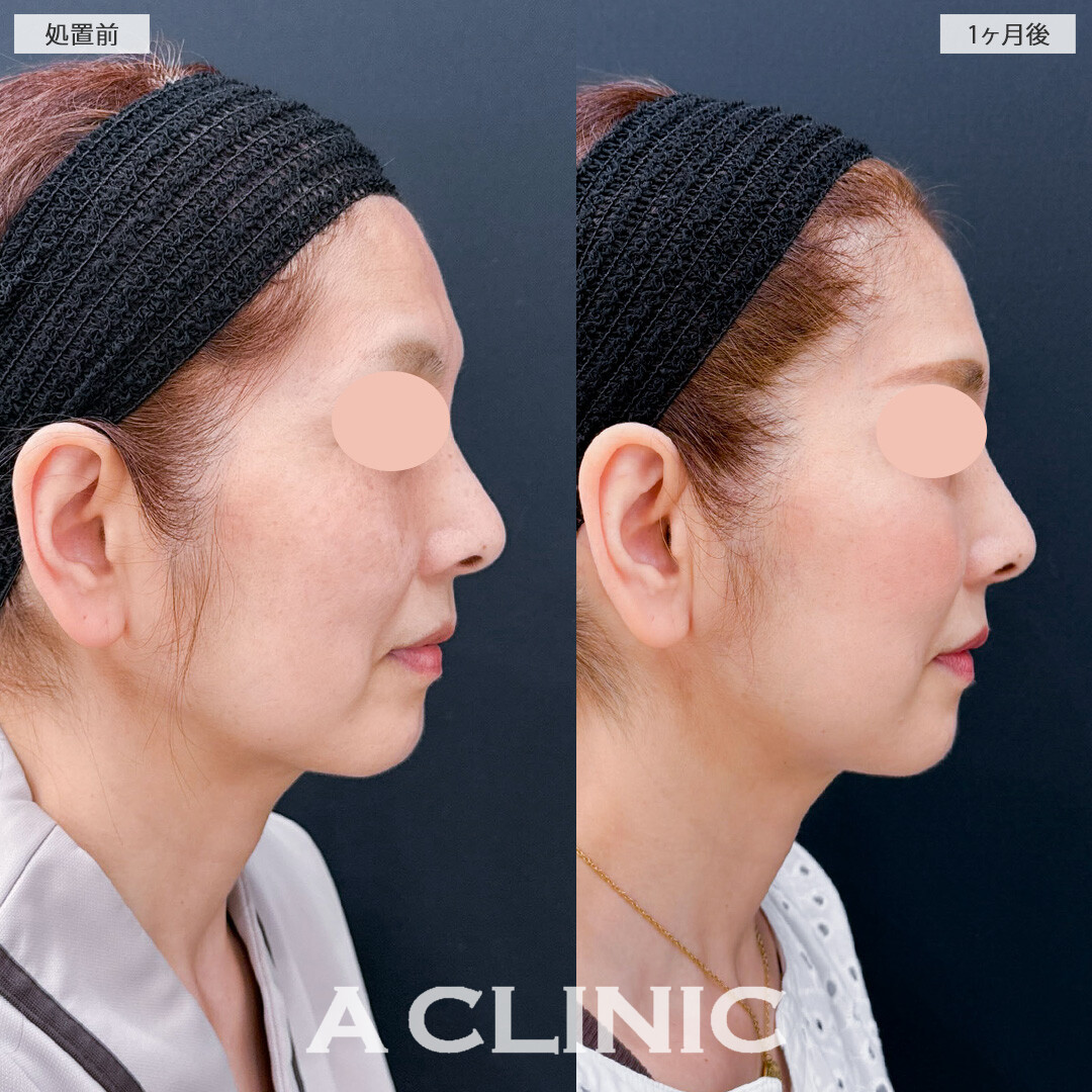 1day小顔脂肪吸引でもたつきをすっきりさせ360度どこから見ても若々しい小顔に！こちら処置前と1か月後の症例です(50代女性)