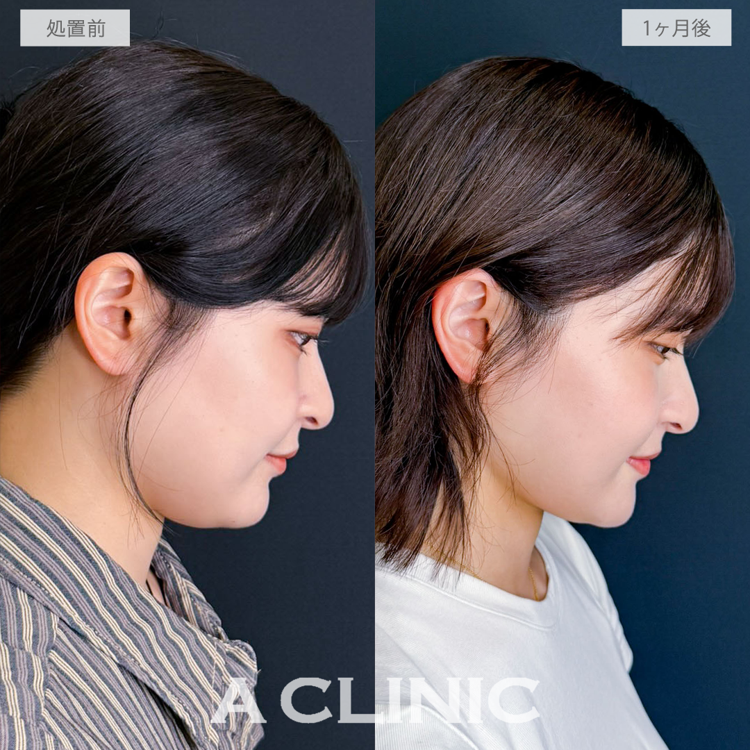 1day小顔脂肪吸引でフェイスラインとあご下をすっきりさせて美シルエットの小顔へ！こちら処置前と1か月後の症例です(20代女性)
