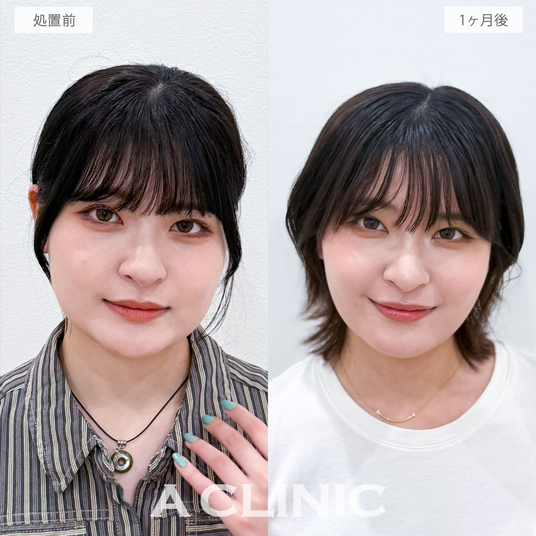 1day小顔脂肪吸引でフェイスラインとあご下をすっきりさせて美シルエットの小顔へ！こちら処置前と1か月後の症例です(20代女性)