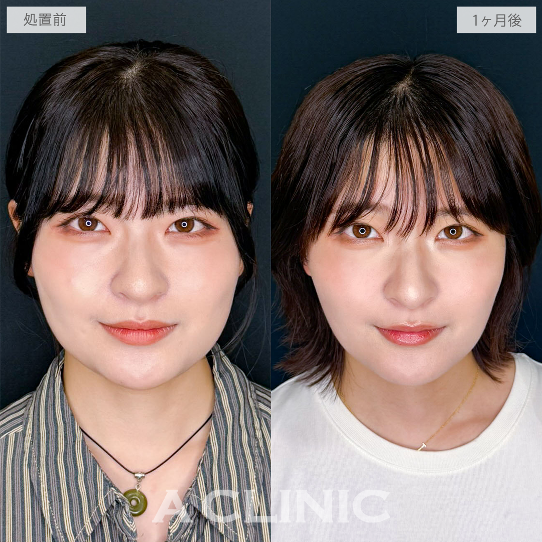 1day小顔脂肪吸引でフェイスラインとあご下をすっきりさせて美シルエットの小顔へ！こちら処置前と1か月後の症例です(20代女性)