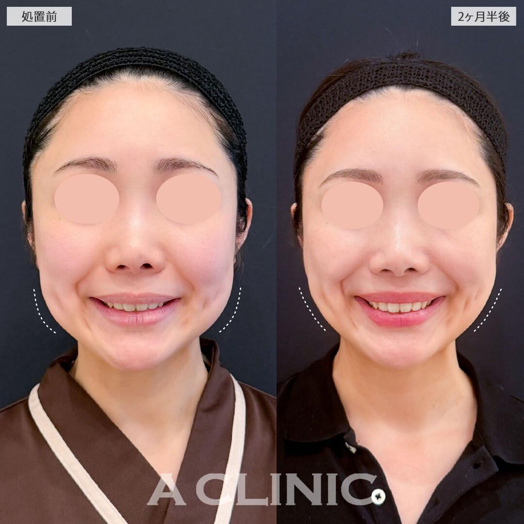 1day小顔脂肪吸引とバッカルファット除去術でなめらかな美しい輪郭になりました！こちら処置前と2ヶ月半後の症例です(30代女性)
