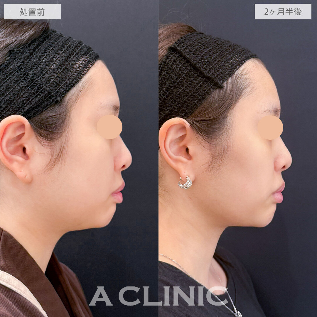 1day小顔脂肪吸引でフェイスラインの境界線を際立たせ横顔を美しく！こちら処置前と2ヶ月半後の症例です(20代女性)