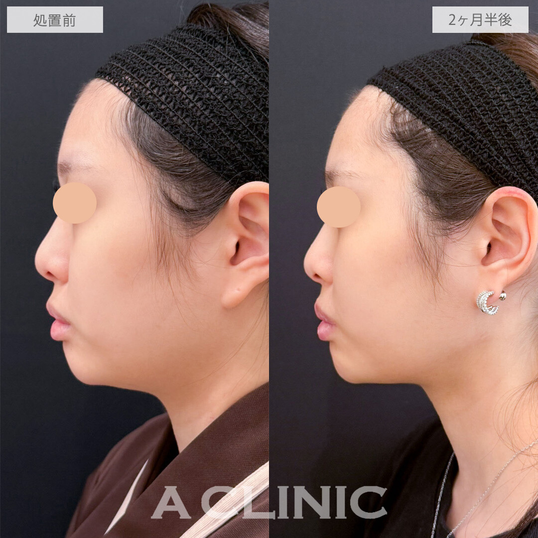1day小顔脂肪吸引でフェイスラインの境界線を際立たせ横顔を美しく！こちら処置前と2ヶ月半後の症例です(20代女性)