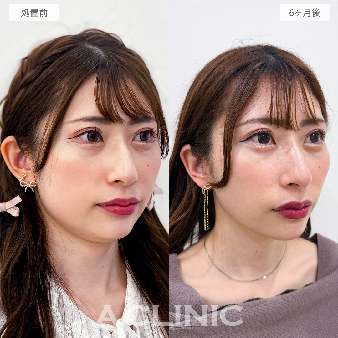 1day小顔脂肪吸引で半年後さらに美しいフェイスラインに！こちら処置前と6ヶ月後の症例です(30代女性)