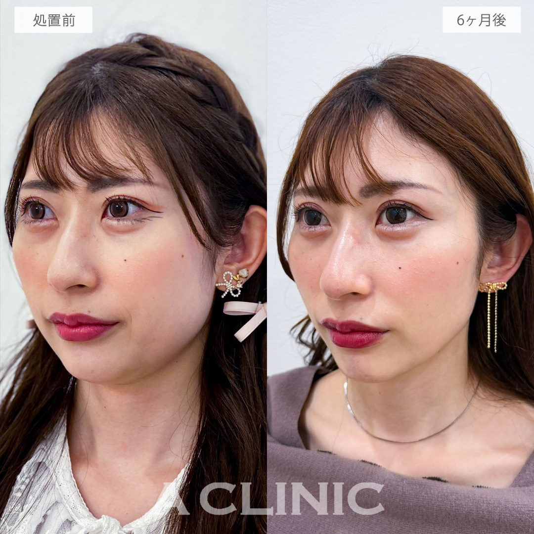 1day小顔脂肪吸引で半年後さらに美しいフェイスラインに！こちら処置前と6ヶ月後の症例です(30代女性)