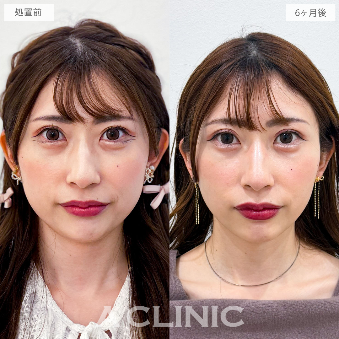 1day小顔脂肪吸引で半年後さらに美しいフェイスラインに！こちら処置前と6ヶ月後の症例です(30代女性)