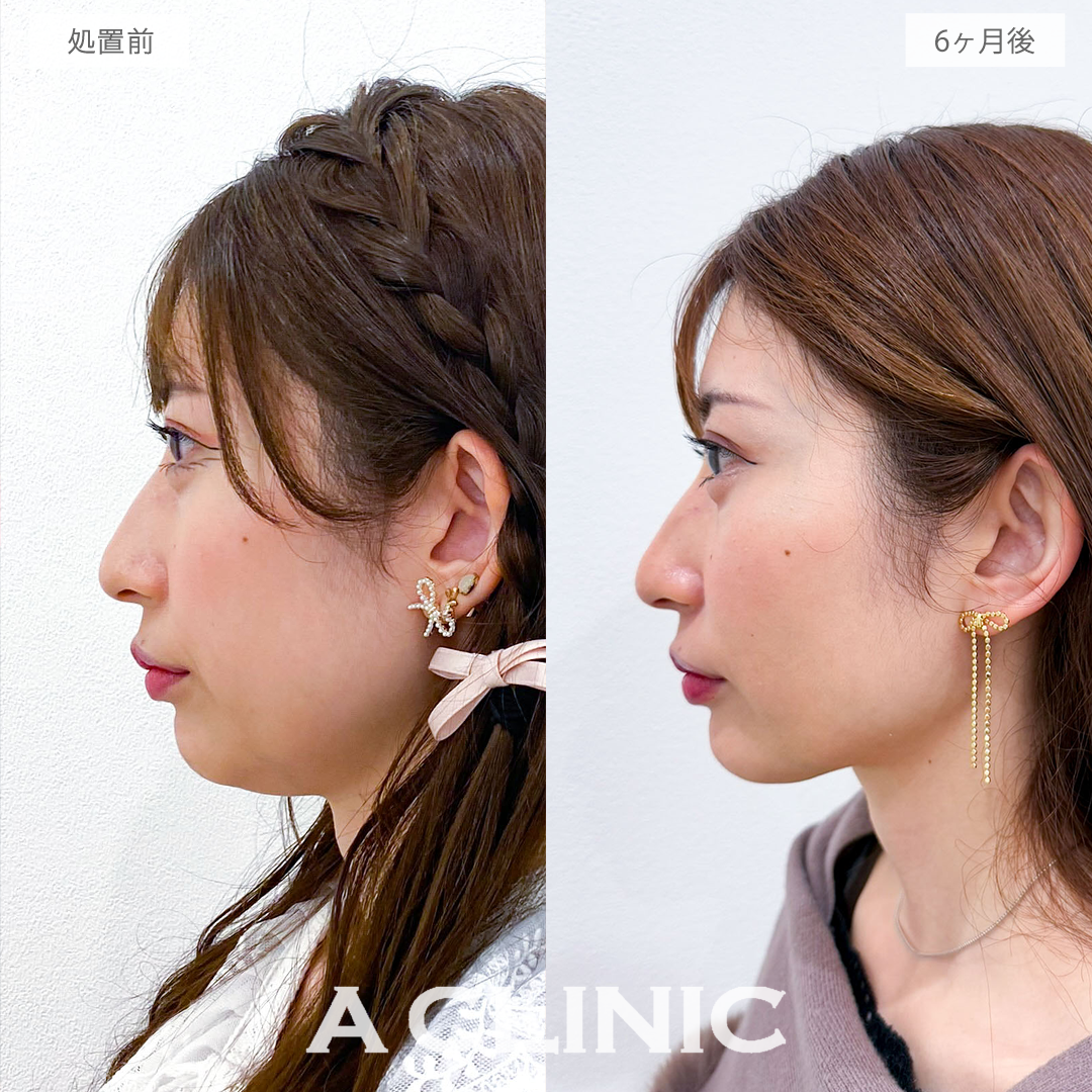 1day小顔脂肪吸引で半年後さらに美しいフェイスラインに！こちら処置前と6ヶ月後の症例です(30代女性)