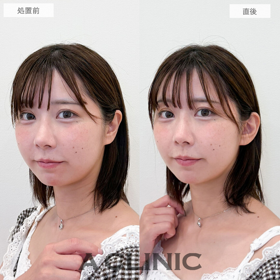 立ち耳ヒアルロン酸注入(ボリューマ)で切らない縫わない注入のみで小顔が叶いました！処置前と直後の症例です(30代女性)