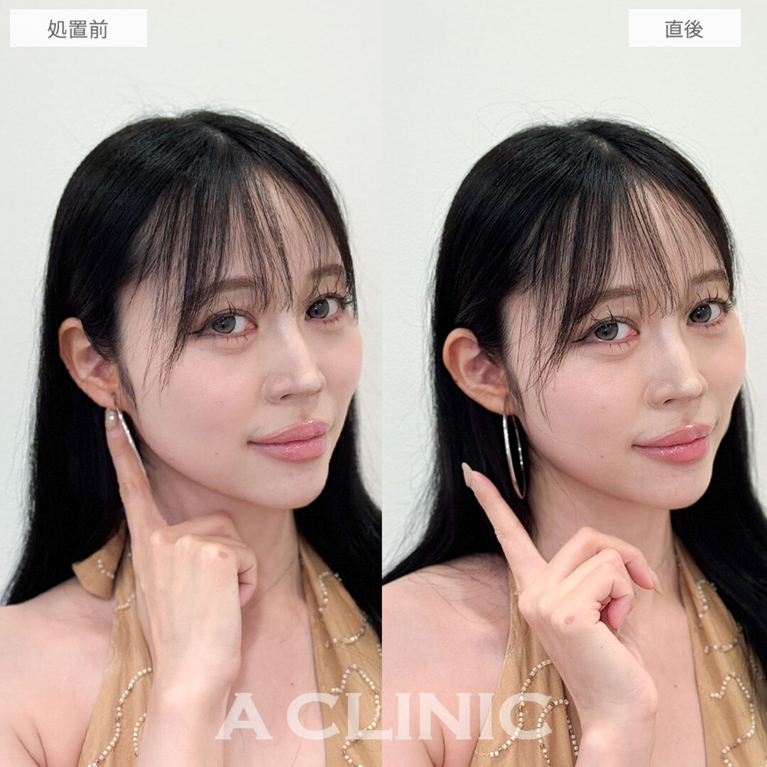 立ち耳ヒアルロン酸注入(ボリューマ)で中顔面短縮！こちら処置前と直後の症例です(20代女性)
