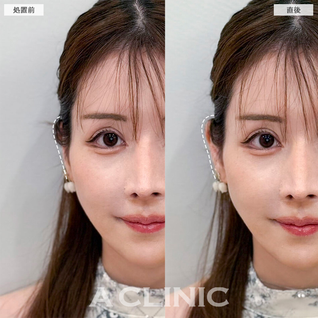 立ち耳ヒアルロン酸注入(ボリューマ)で正面から見た時の耳の存在感アップ！処置前と直後の症例です(30代女性)