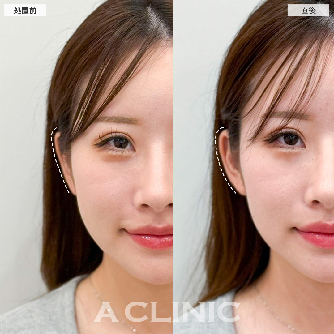 立ち耳ヒアルロン酸注入(ボリューマ)で耳元の存在感アップ！処置前と直後の症例です(20代女性)