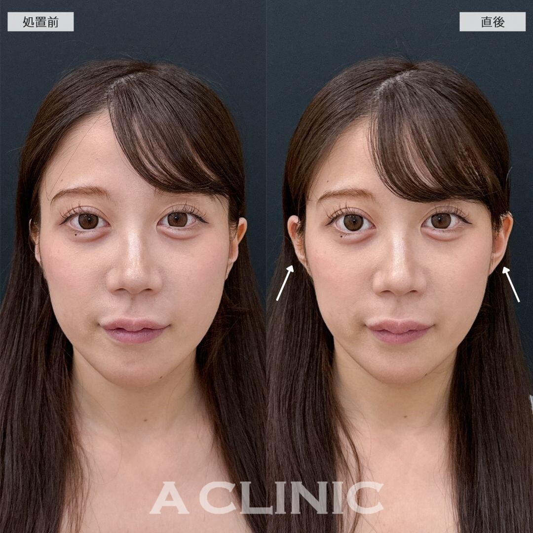 耳の形を整えるだけで小顔効果抜群！立ち耳ヒアルロン酸注入(ボリューマ)の処置前と直後の症例です(20代女性)