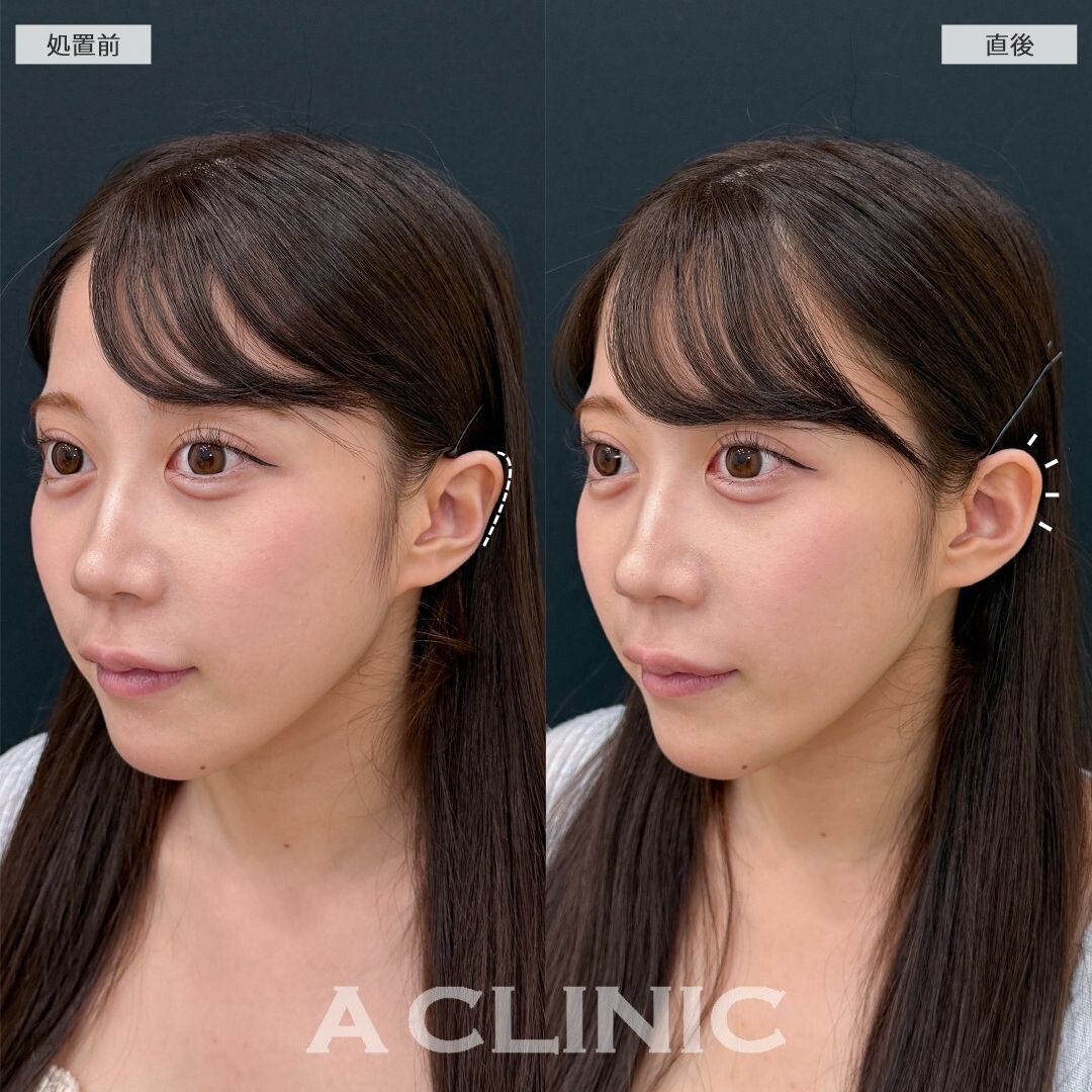 耳の形を整えるだけで小顔効果抜群！立ち耳ヒアルロン酸注入(ボリューマ)の処置前と直後の症例です(20代女性)