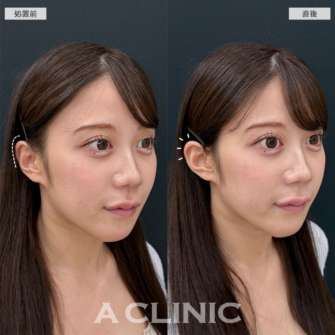 耳の形を整えるだけで小顔効果抜群！立ち耳ヒアルロン酸注入(ボリューマ)の処置前と直後の症例です(20代女性)