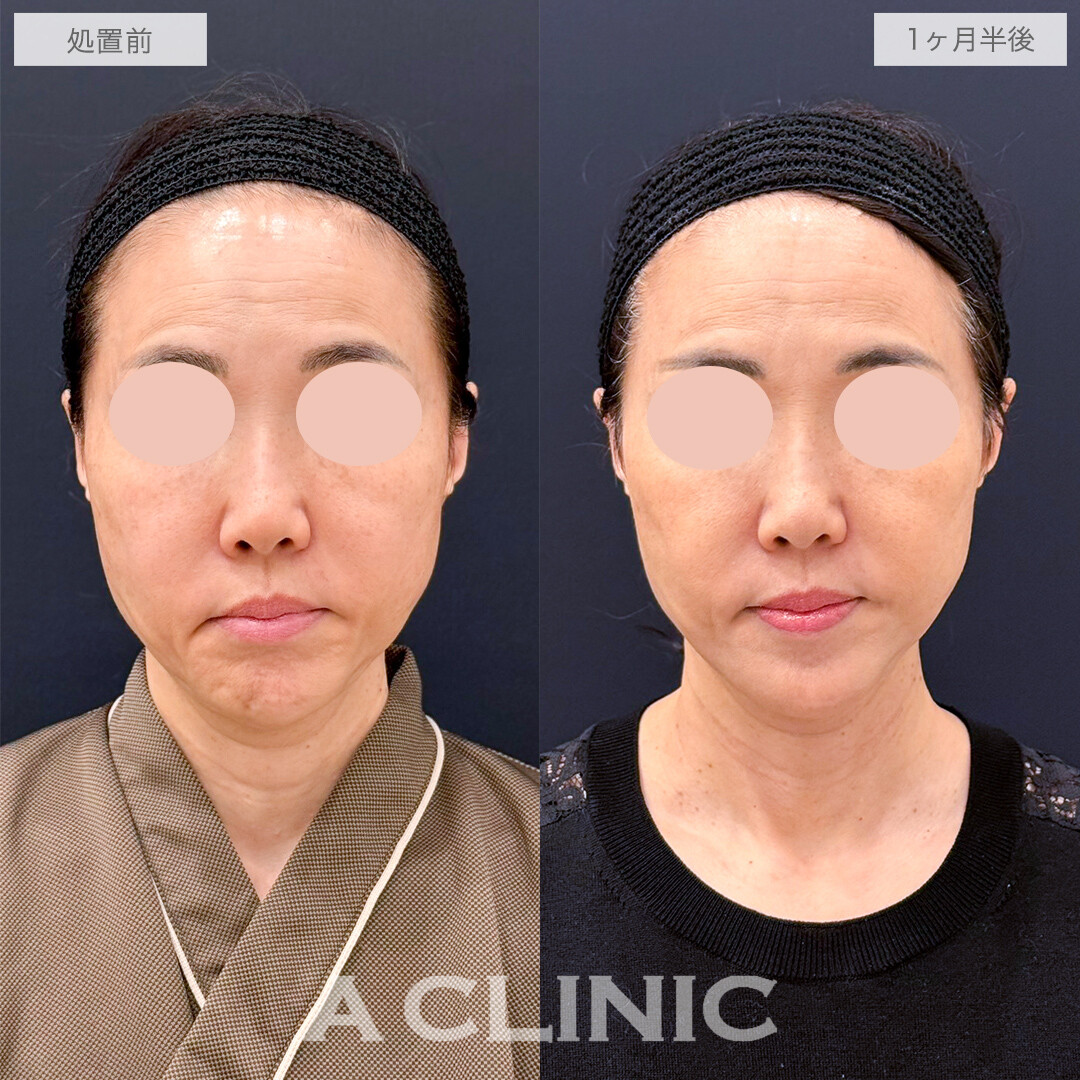 【傷跡の経過あり】A式たるみ切開でたるみが消えてさらに小顔に！処置前と1ヶ月半後の症例です(50代女性)