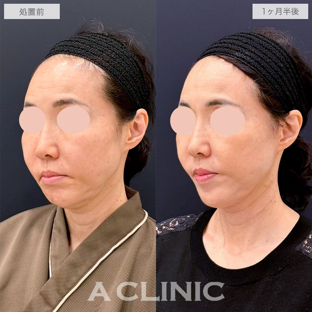 【傷跡の経過あり】A式たるみ切開でたるみが消えてさらに小顔に！処置前と1ヶ月半後の症例です(50代女性)