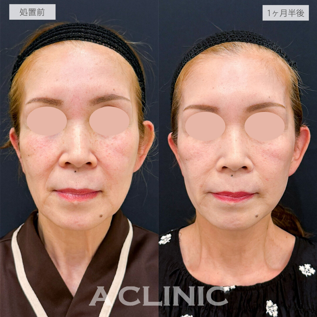 【直後の傷跡あり】A式たるみ切開で口横のたるみを整え若々しいフェイスラインに！こちら処置前と1ヶ月半後の症例です(50代女性)