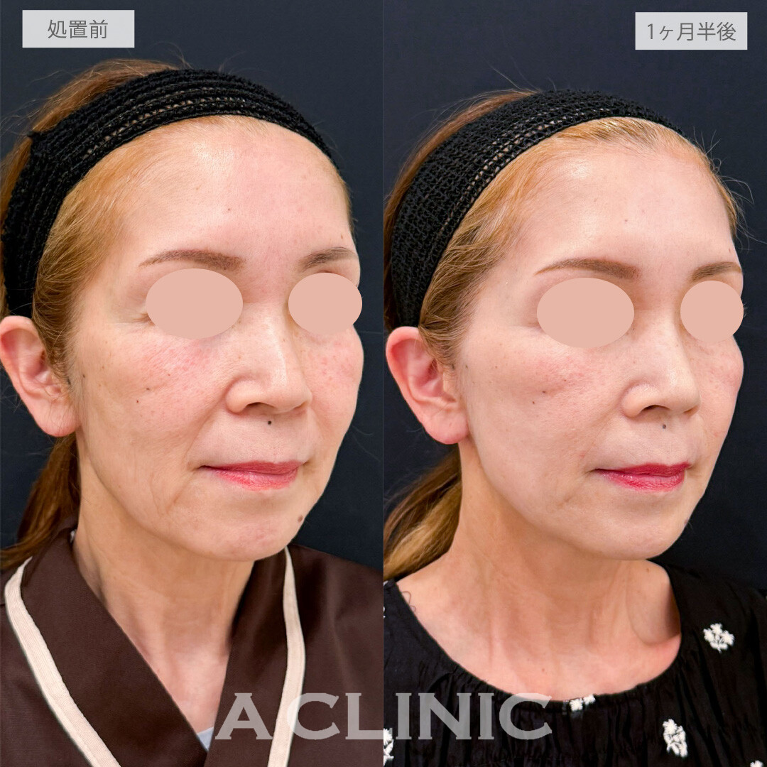 【直後の傷跡あり】A式たるみ切開で口横のたるみを整え若々しいフェイスラインに！こちら処置前と1ヶ月半後の症例です(50代女性)