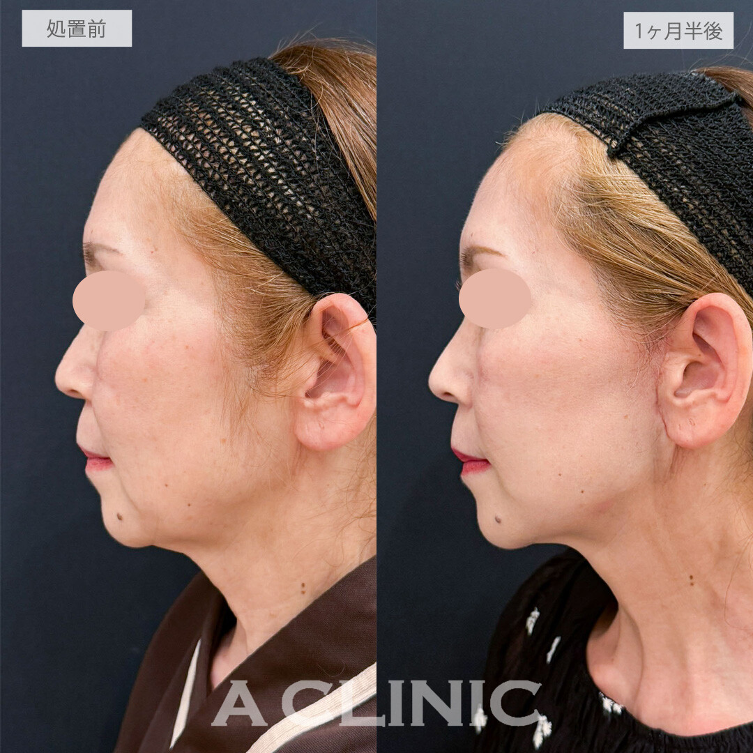 【直後の傷跡あり】A式たるみ切開で口横のたるみを整え若々しいフェイスラインに！こちら処置前と1ヶ月半後の症例です(50代女性)