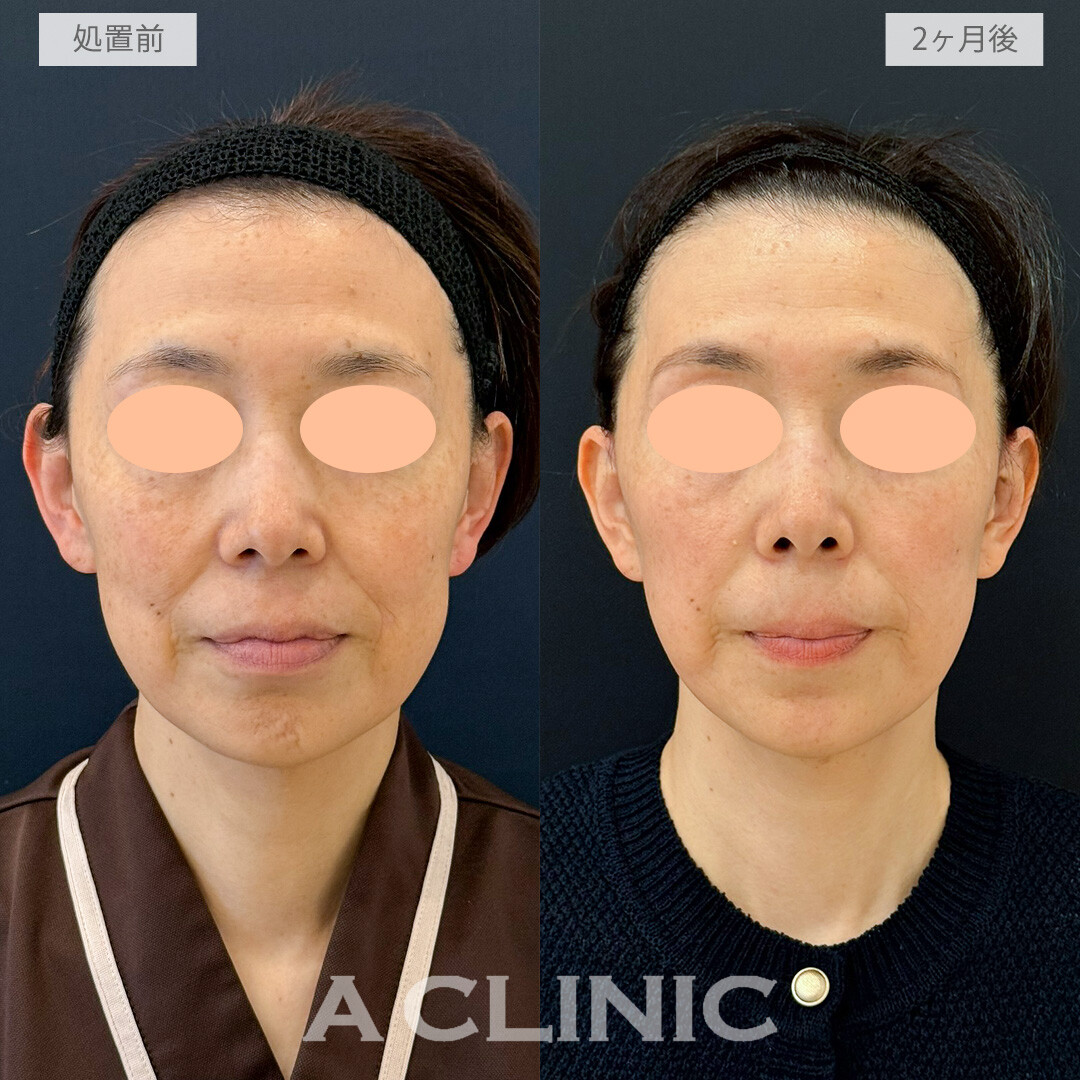 A式たるみ切開でほうれい線が薄くなりました！こちら処置前と2ヶ月後の症例です(40代女性)