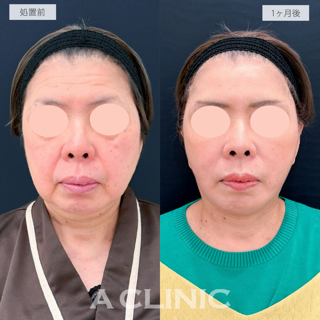 A式たるみ切開と1day小顔脂肪吸引で老け顔要因の脂肪と皮膚のたるみを一気に解消し圧倒的な若返り！処置前と1ヶ月後の症例です(60代女性)