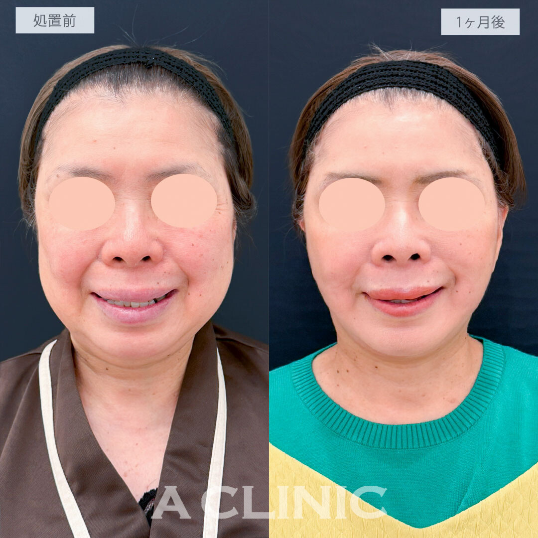 A式たるみ切開と1day小顔脂肪吸引で老け顔要因の脂肪と皮膚のたるみを一気に解消し圧倒的な若返り！処置前と1ヶ月後の症例です(60代女性)