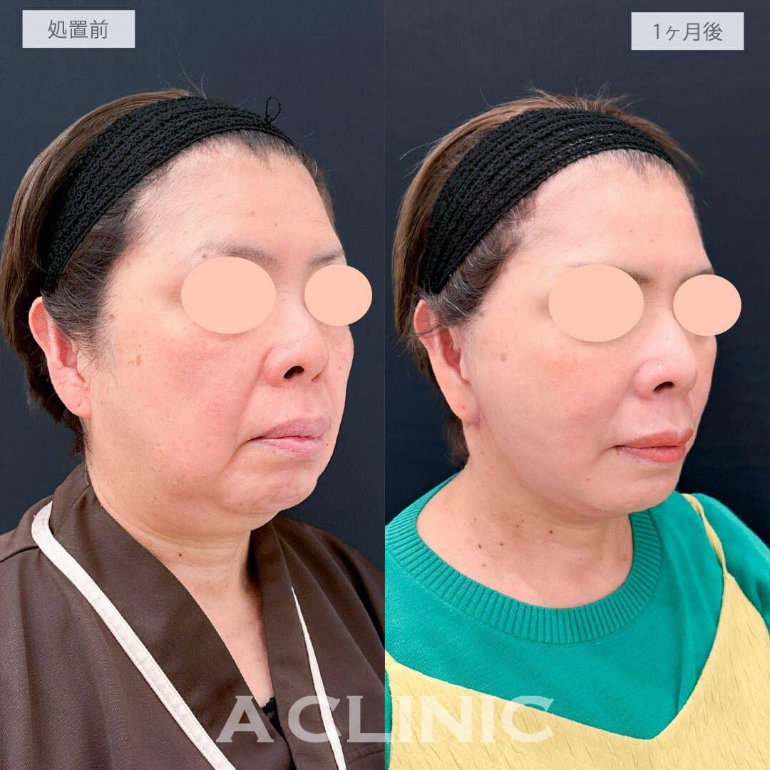 A式たるみ切開と1day小顔脂肪吸引で老け顔要因の脂肪と皮膚のたるみを一気に解消し圧倒的な若返り！処置前と1ヶ月後の症例です(60代女性)