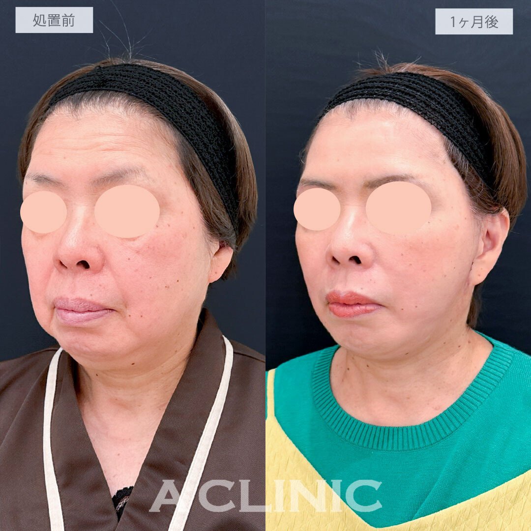 A式たるみ切開と1day小顔脂肪吸引で老け顔要因の脂肪と皮膚のたるみを一気に解消し圧倒的な若返り！処置前と1ヶ月後の症例です(60代女性)