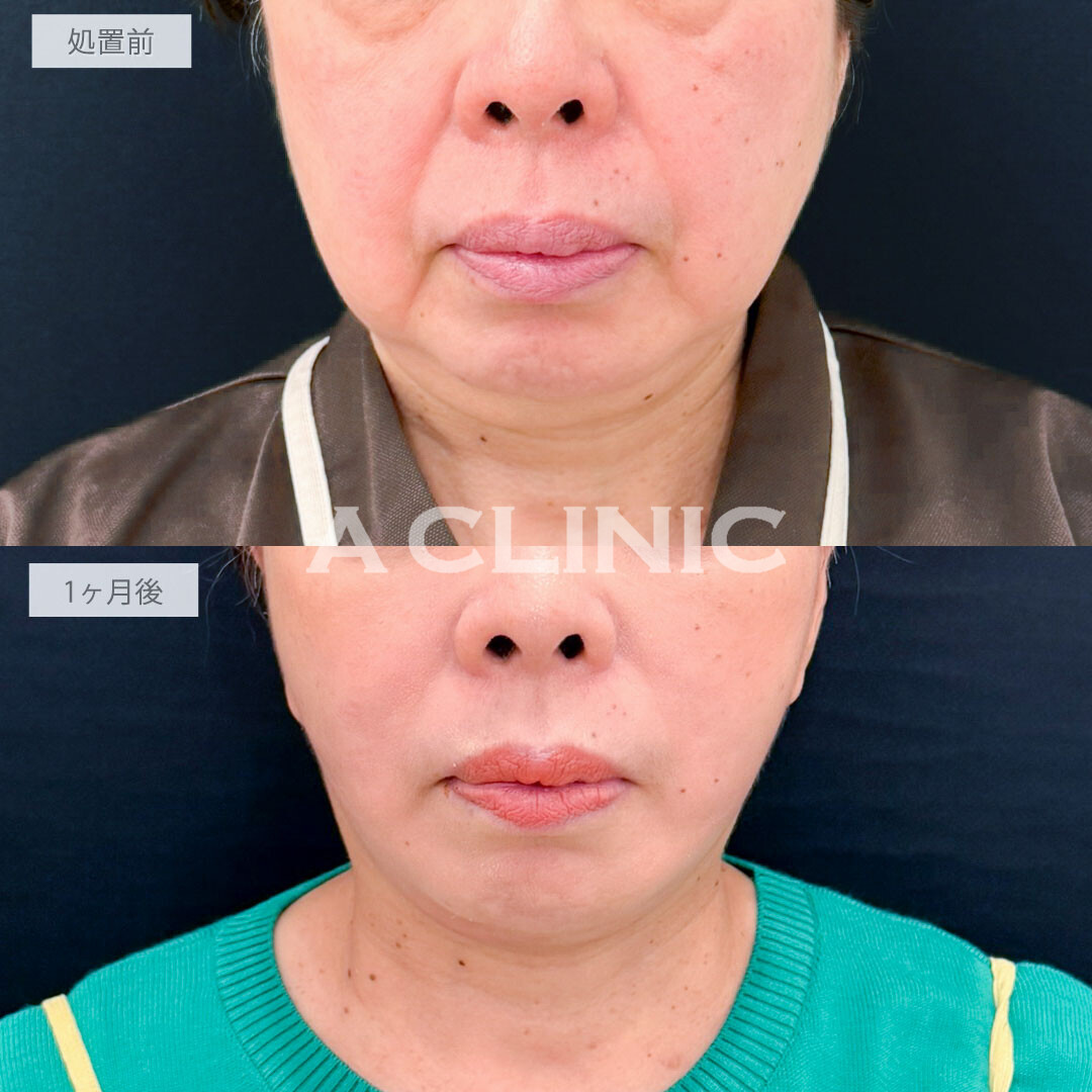 A式たるみ切開と1day小顔脂肪吸引で老け顔要因の脂肪と皮膚のたるみを一気に解消し圧倒的な若返り！処置前と1ヶ月後の症例です(60代女性)