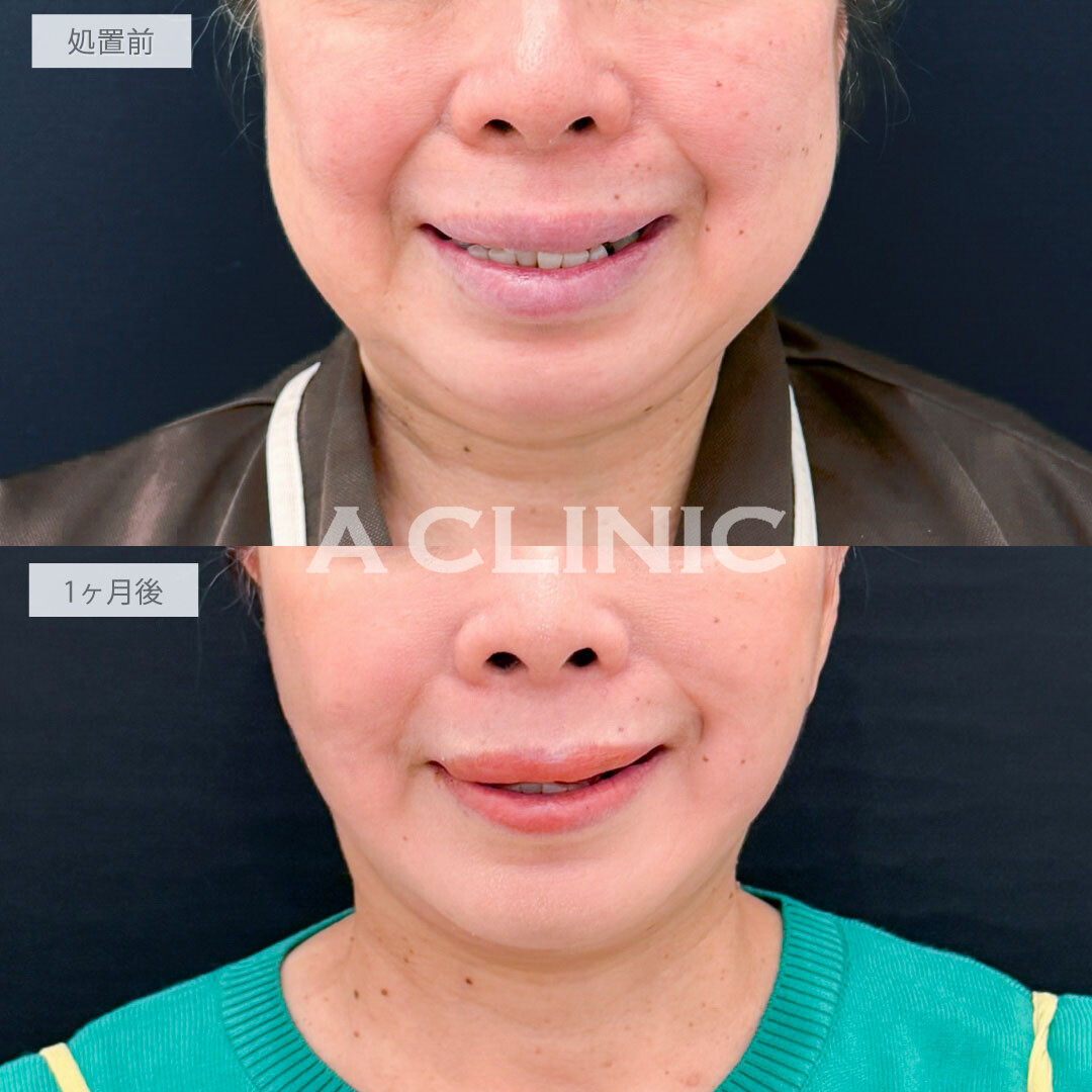 A式たるみ切開と1day小顔脂肪吸引で老け顔要因の脂肪と皮膚のたるみを一気に解消し圧倒的な若返り！処置前と1ヶ月後の症例です(60代女性)