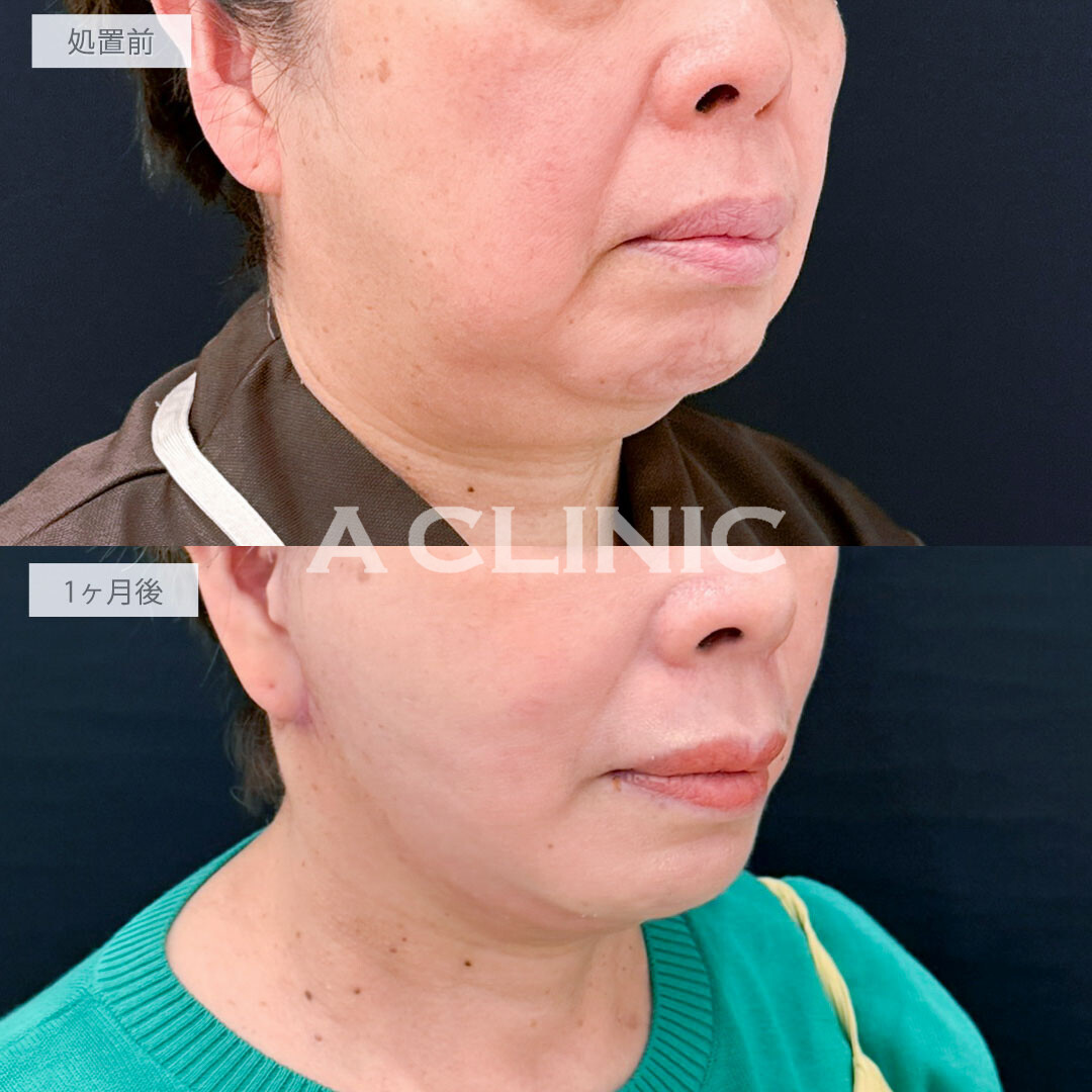 A式たるみ切開と1day小顔脂肪吸引で老け顔要因の脂肪と皮膚のたるみを一気に解消し圧倒的な若返り！処置前と1ヶ月後の症例です(60代女性)