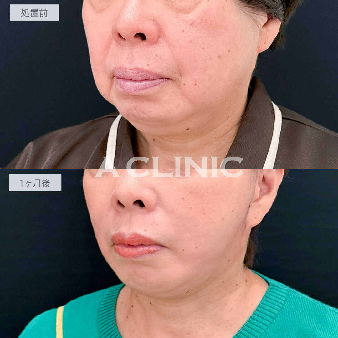 A式たるみ切開と1day小顔脂肪吸引で老け顔要因の脂肪と皮膚のたるみを一気に解消し圧倒的な若返り！処置前と1ヶ月後の症例です(60代女性)